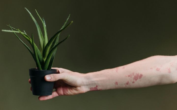 Rashes – Causes, Types, Symptoms, and Treatments